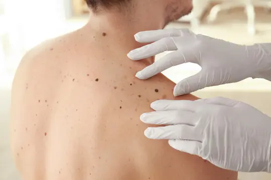 Imagem ilustrativa de Cirurgia dermatológica em Uberlândia